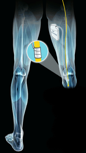 Image: Electrode blocking residual peripheral nerve trunk (Photo courtesy of Neuros Medical).